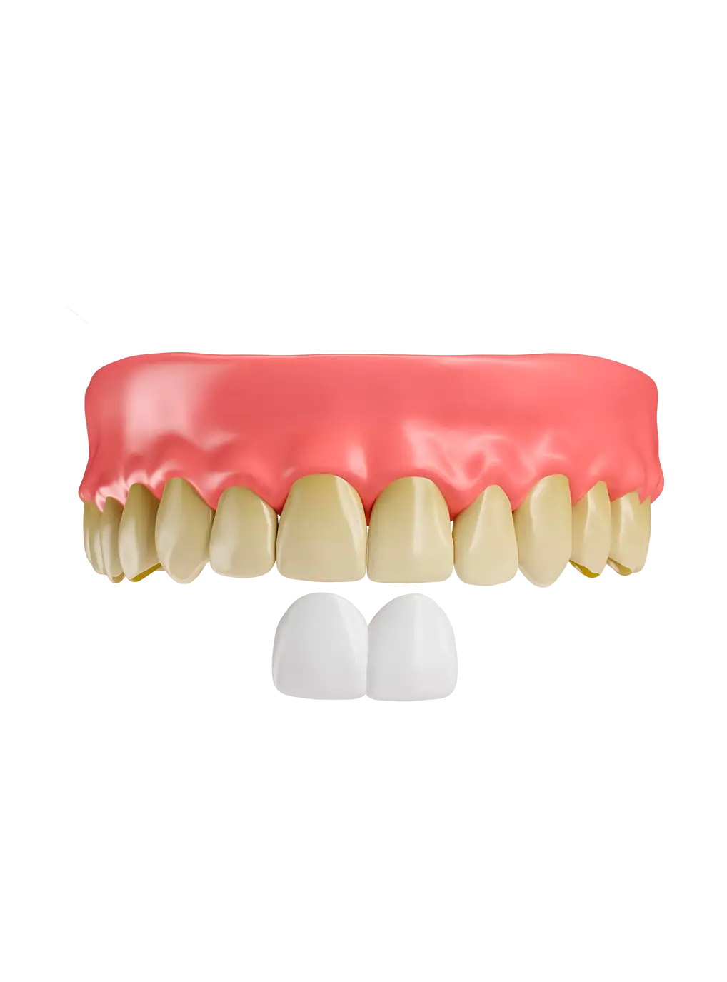 facetas de porcelana em rio do sul
