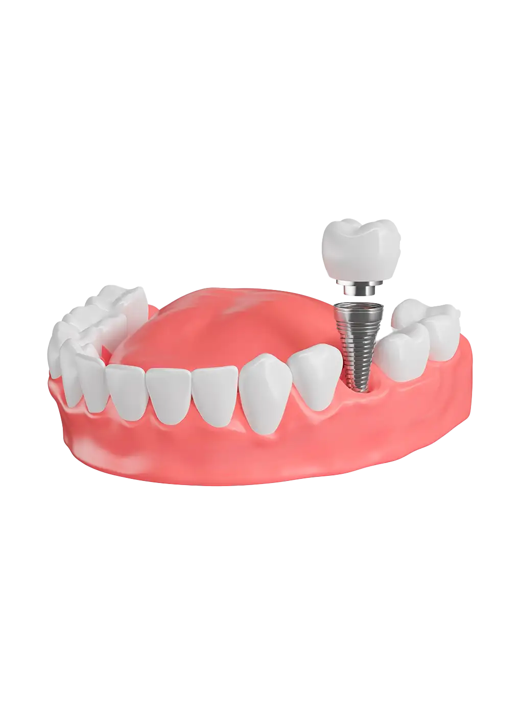 protese de protocolo rio do sul